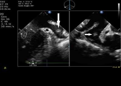 score 0 Guidelines AF ablation no