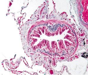 obstruction Alveolar destruction: