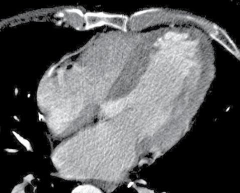 Eur Heart J 2012; 33(1): 67-77. τους George και συν. 8 δημοσιεύτηκε το 2009.