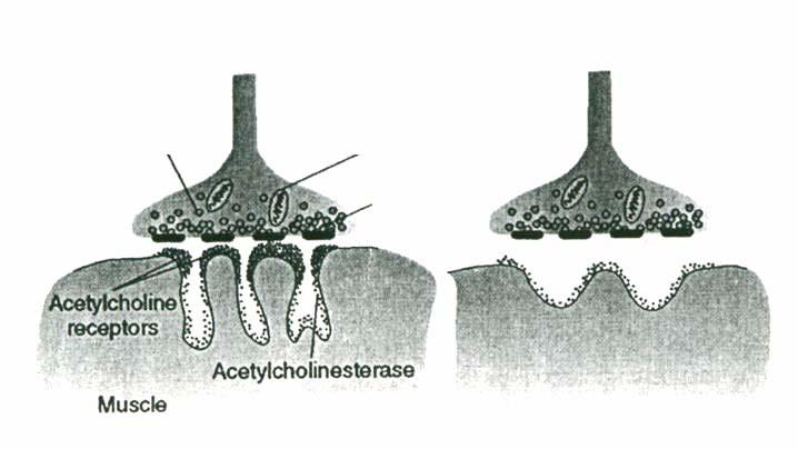 Θεωρητικό µέρος 2 Α Β Συναπτικό Νευρική Σηµείο απελευθέρωσης της ACh Υποδοχείς της ακετυλοχολίνης Εικόνα 12: Σχηµατική αναπαράσταση νευροµυϊκής σύναψης φυσιολογικού (Α) και µυασθενικού (Β) ατόµου