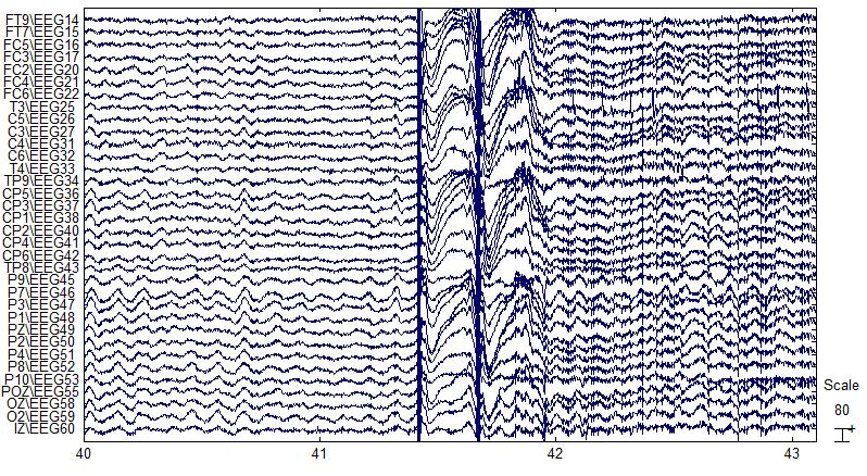 Τα πραγματικά δεδομένα που χρησιμοποιήσαμε αφορούν ηλεκτροεγκεφαλογραφήματα (EEG) ασθενών με επιληψία και υγειών ατόμων μετά από την παροχή διακρανιακού μαγνητικού ερεθισμού (Transcranial magnetic