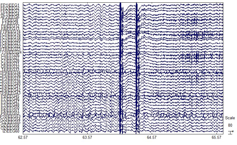 Χρησιμοποιήσαμε τις αρχικές παρατηρήσεις από 35 πολυ-κάναλες εξω-κρανιακές καταγραφές EEG που αφορούν 24 ασθενείς που πάσχουν από επιληψία και 11 υγιή άτομα, αμέσως μετά την παροχή του δεύτερου TMS