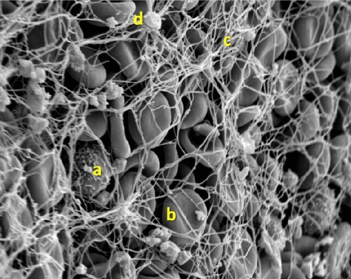 at 3000x erythrocytes (b) trapped in a fibrin mesh (c) with few platelet aggregates (d) and rare white cells