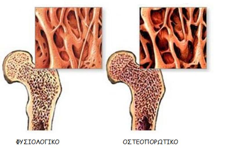 ΟΣΤΕΟΠΟΡΩΣΗ Ø ΑΠΟΤΕΛΕΙ ΑΣΘΕΝΕΙΑ ΤΟΥ ΣΚΕΛΕΤΙΚΟΥΣΥΣΤΗΜΑΤΟΣ Ø ΧΑΡΑΚΤΗΡΙΖΕΤΑΙ ΑΠΟ ΧΑΜΗΛΗ ΟΣΤΙΚΗ ΜΑΖΑ ΚΑΙ ΤΗΝ ΕΞΑΣΘΕΝΗΣΗ ΤΟΥ ΟΣΤΙΤΗ ΙΣΤΟΥ ΣΕ
