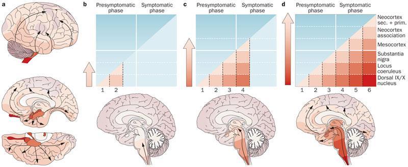 Τα κατα Braak στάδια νευροεκφύλισης* στη ν. Πάρκινσον έχουν αντίστοιχη κλινική εκπροσώπιση και συσχέτηση με την αναπηρία.