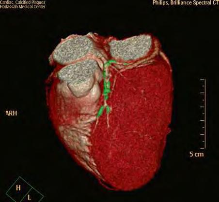 regions of high attenuation such as abdomen, pelvis and large patients in general). In addition, the high energy spectrum (recorded by the lower layer) is very hard (i.e. with little low energy components) due to the strong filtration by the first layer.