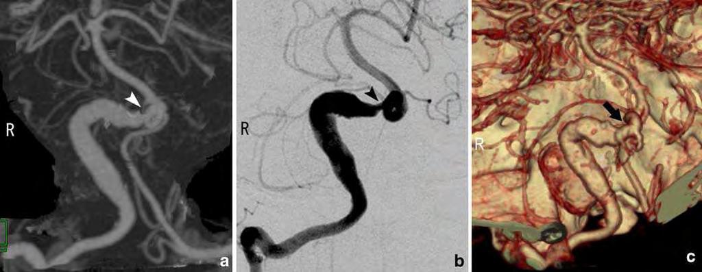 DE bone removal is an automatic postprocessing algorithm which uses DE material differentiation to generate a bone mask and to subtract it from the DE-CTA dataset.