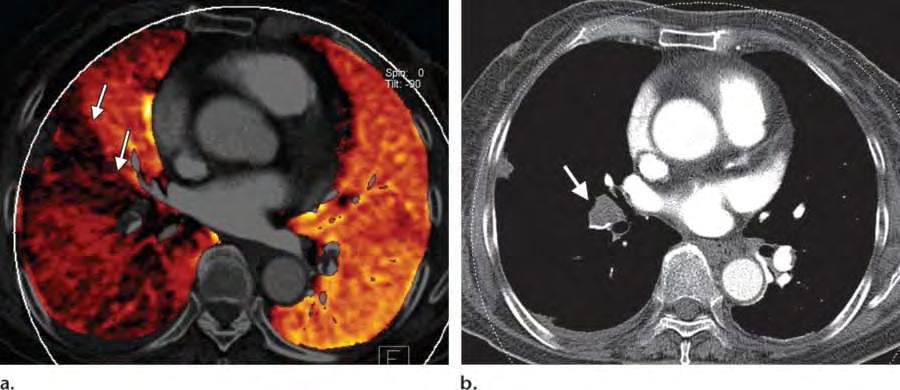 selection of lung areas with impaired function prior to lung volume reduction surgery, or in the assessment of therapy response. Stable xenon (Xe, atomic number Z = 54, K edge: 34.