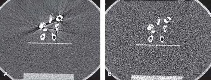 Figure 5.31: Metal artifact reduction using virtual monochromatic images synthesized from dual-source dualenergy CT data using image-space techniques. A.