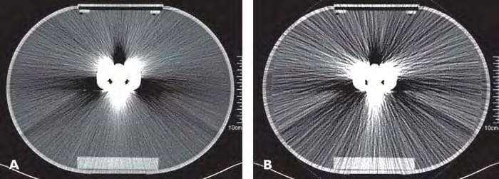 Monochromatic image at 127 kev was generated from dual-energy scan with same scanner output (volumect dose index) as used in single-energy scan.