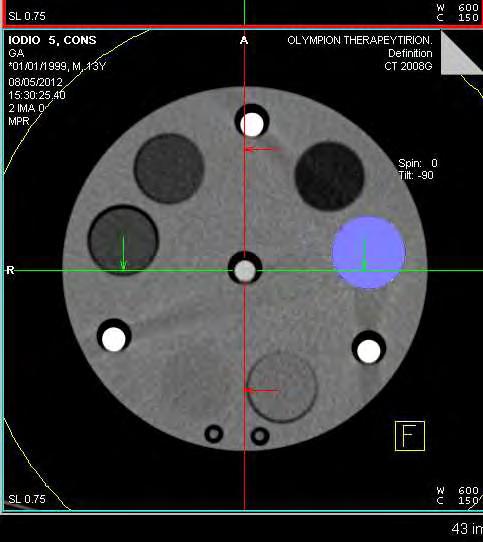 mm DE images before and after bone removal) revealed that the mean CT number values of iodine solutions and material inserts remained practically unchanged after bone removal.