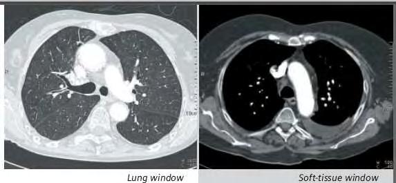 Figure 3.10: Lung window and Soft tissue window (www.siemens.com) 3.7.2 TWO-DIMENSIONAL DISPLAYS CT mainly uses the transverse plane as the imaging plane.