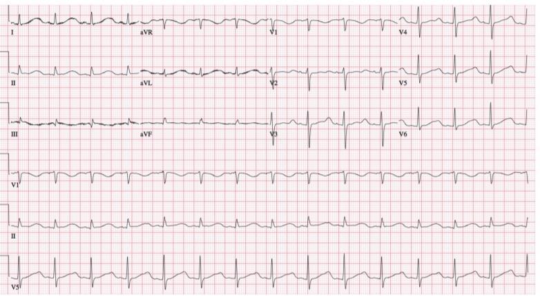 Sudden Cardiac Death, Mitral Valve Prolapse, and Long QT Syndrome The American Journal of Medicine, Vol 128, No 10,
