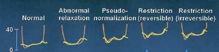 75 DT>240 ms IVRT>90 ms E/A=0.75-1.