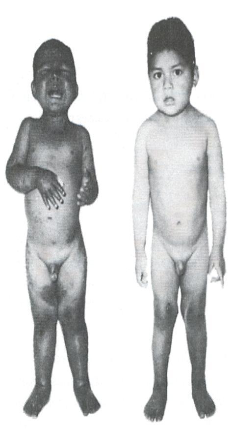 KWASHIORKOR Mεγαλύτερα παιδιά (1-3 ετών) Μειωμένη πρόσληψη πρωτεϊνης ή πιο συχνά παρουσία λοιμώξεων Ταχεία εμφάνιση: οξύ PEM Κάποια απώλεια βάρους Κάποια έκπτωση μυϊκού