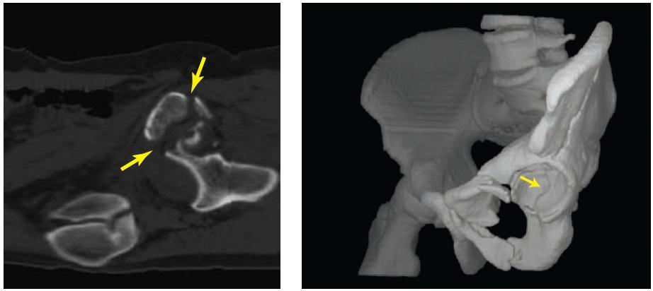 COMPUTED Φ-RAY TOMOGRAPHY Εικόνα αξονικόσ Σομογραφύασ (X-Ray CT): Ένα ορατό κϊταγμα κοτύλησ