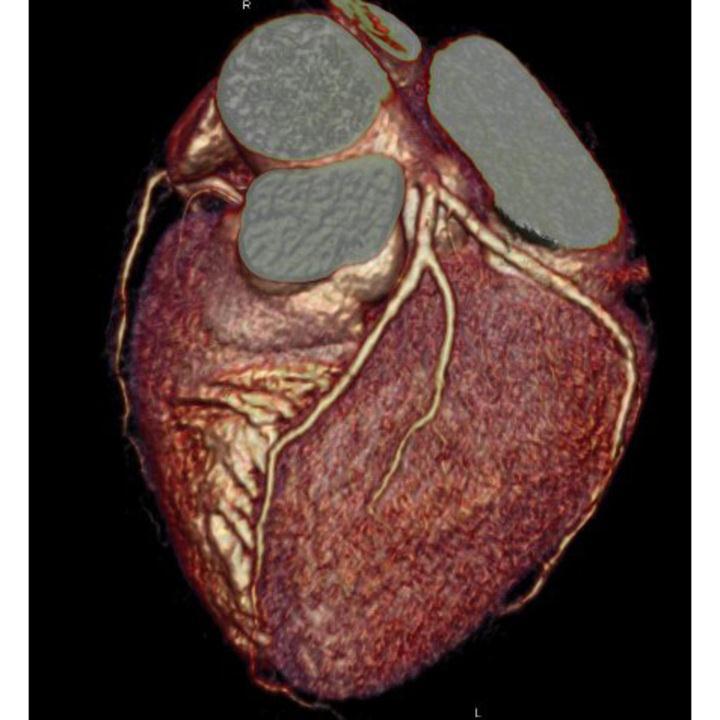 COMPUTED Φ-RAY TOMOGRAPHY Καρδιακό απεικόνιςη διπλόσ ενϋργειασ (Dual