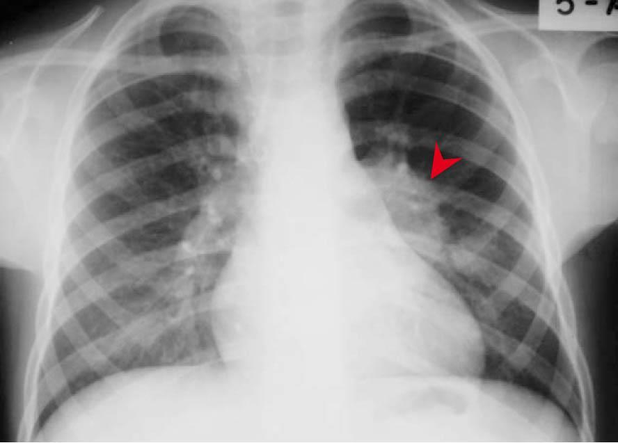 Φυματίωση (Tb) Πρωτοπαθής πνευμονική φυματίωση σε παιδί με λεμφαδενοπάθεια ->> Ακτινολογικά ευρήματα: Κεχροειδης φυματίωση: Κυρίως σε βρέφη, υπερήλικες ή ασθενείς με ανοσοκαταστολή.