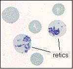 Δικτυοερυθροκύτταρα Νεαρά ερυθροκύτταρα, με υπόλειμμα RNA