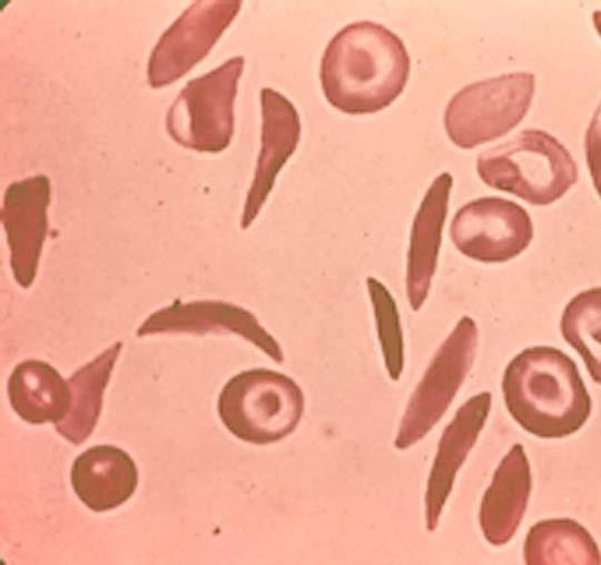 Δρεπανοκύτταρα Δρεπανοκυτταρική αιμοσφαιρίνη (HbS): παθολογική αιμοσφαιρίνη η οποία σε συνθήκες υποξίας προκαλεί