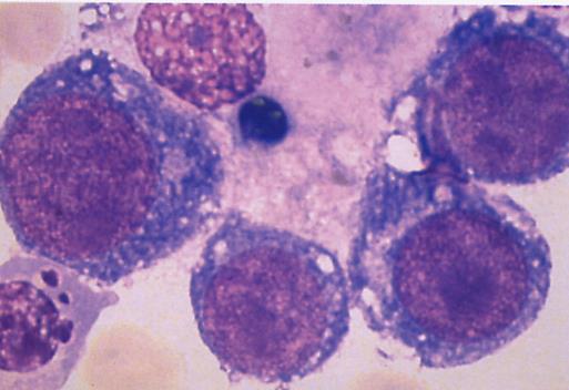 ΟΜΛ Επίχρισμα Αίματος, Μυελού M6 Ερυθρολευχαιμία: 50% άωρες μορφές ερυθράς σειράς στο σύνολο των κυττάρων δυσπλαστικοί, μεγαλοβλαστοειδείς χαρακτήρες, πολυπύρηνοι 20%