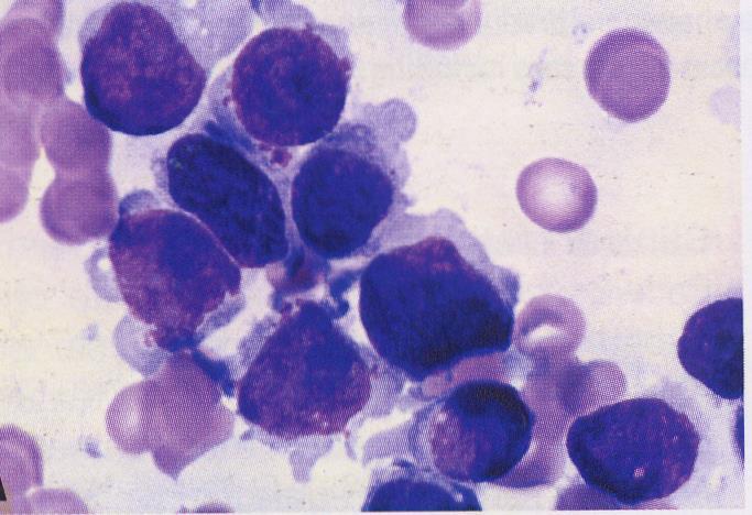 ΟΜΛ Επίχρισμα Αίματος, Μυελού M7 50% κυττάρων μυελού μεγακαρυοβλάστες Μεσαίου-μεγάλου μεγέθους Στρογγυλός πυρήνας