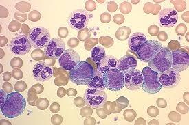 Αριστερή στροφή Άωρες μορφές της κοκκιώδους σειράς στο αίμα Βαριές συστηματικές μικροβιακές