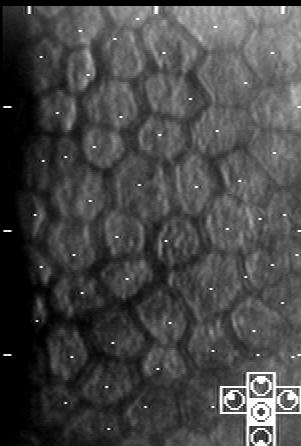 Εικόνα 21. Ένας άλλος τύπος διπλού ορίου επηρεάζει μόνο ορισμένα κύτταρα (εικόνα 21). Σ αυτή την περίπτωση το διπλό όριο βρίσκεται μέσα στο κύτταρο.