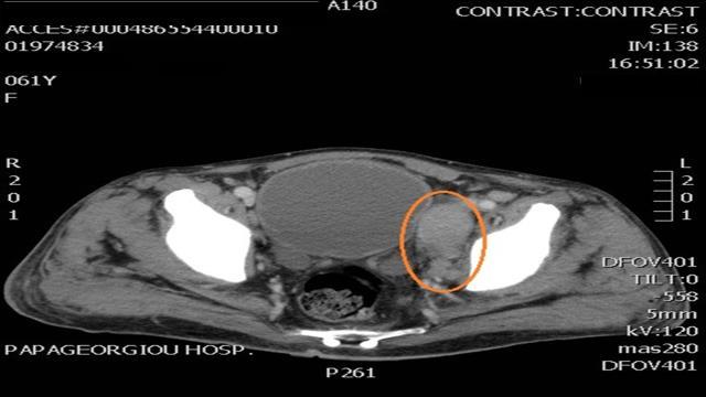 Σταδιοποίηση CT ΑΚΚΟ: διόγκωση και ασαφή όρια