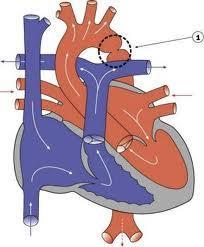 1.1.ΕΙΣΑΓΩΓΗ: Η στένωση του ισθμού της αορτής (ΣΙΑ) αποτελεί συγγενή καρδιοπάθεια, κατά την οποία προκαλείται διαφόρου βαθμού στένωση στο σημείο μετάπτωσης του αορτικού τόξου σε κατιούσα αορτή,