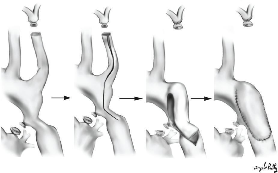 aortoplasty): Εκτεταμένη αρτηριοτομή κατά