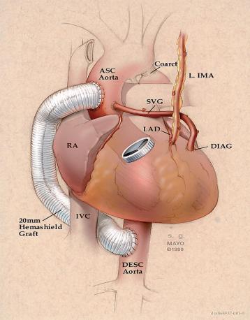 Εικόνα 21: Αορτική παράκαμψη με μόσχευμα Εικόνα 22: Balloon Angioplasty με τοποθέτηση stent (Illustrations reprinted from PedHeart Resource. www.heartpassport.com.