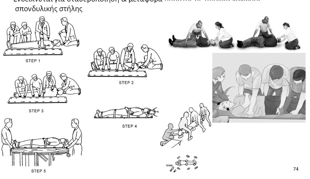 μεταφοράς θύματος Σανίδα Τεχνική τοποθέτησης σε σανίδα Ενδείκνυται για