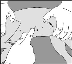 Κάντε μια τομή με νυστέρι, μήκους περίπου 5 mm, κατά μήκος του ανασηκωμένου άκρου του εμφυτεύματος που βρίσκεται πιο κοντά. Σπρώξτε το εμφύτευμα με ήπιες κινήσεις προς το σημείο της τομής.