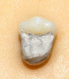 Το ομοιόμορφο πάχος αποκοπής σε κάθε δόντι διασφαλίστηκε με τη χρήση αυλάκων αποκοπής συγκεκριμένων διαστάσεων και τη χρήση διαμαντιών αντίστοιχων διαστάσεων.