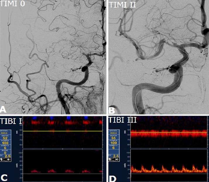 et al. Stroke 2001;32:89-93 Alexandrov et al.