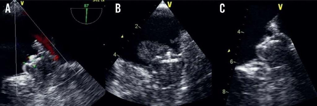 Late organized Left Atrial Thrombus on LAA