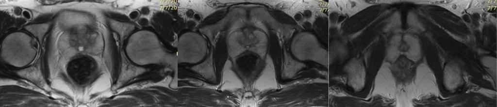 T2W MRI