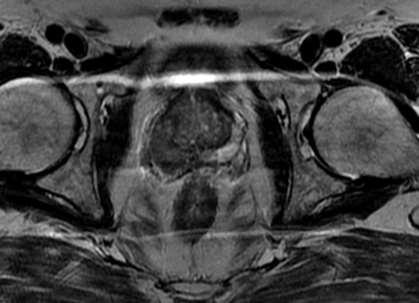 T2W MRI