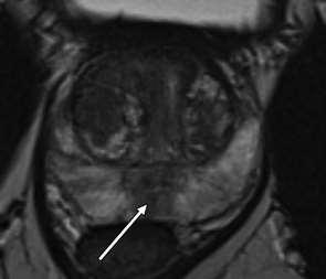 Enlargement of the transition zone due to benign prostatic