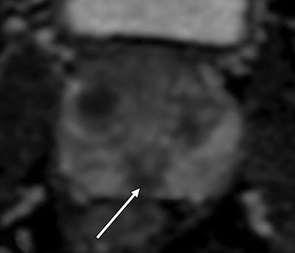central zone and thus poor differentiation of these two zones on