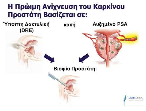 PSA (prostate specific antigen). Most prostate cancers are currently found on the basis of an elevated serum prostate specific antigen (PSA) level.
