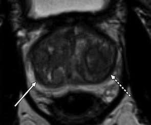 Thickening of surgical capsule Radiologist, Be