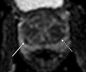 Interpretation of Multiparametric Prostate MRI