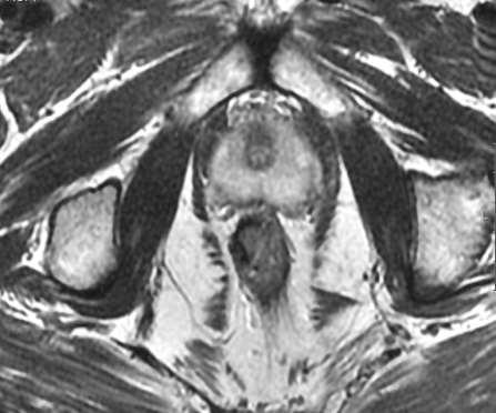 mpmri