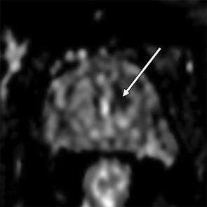 Interpretation of Multiparametric Prostate MRI Andrew