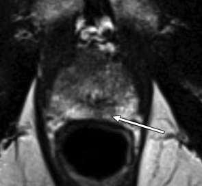 acute and chronic prostatitis and postinflammatory scars
