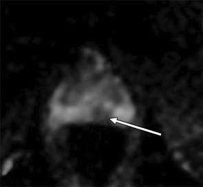 Interpretation of Multiparametric Prostate MRI Andrew B.