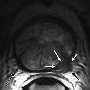 Staging Local staging of prostate cancer with endorectal MR imaging: correlation with histopathology.