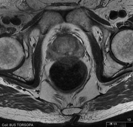 Staging When mpmri is